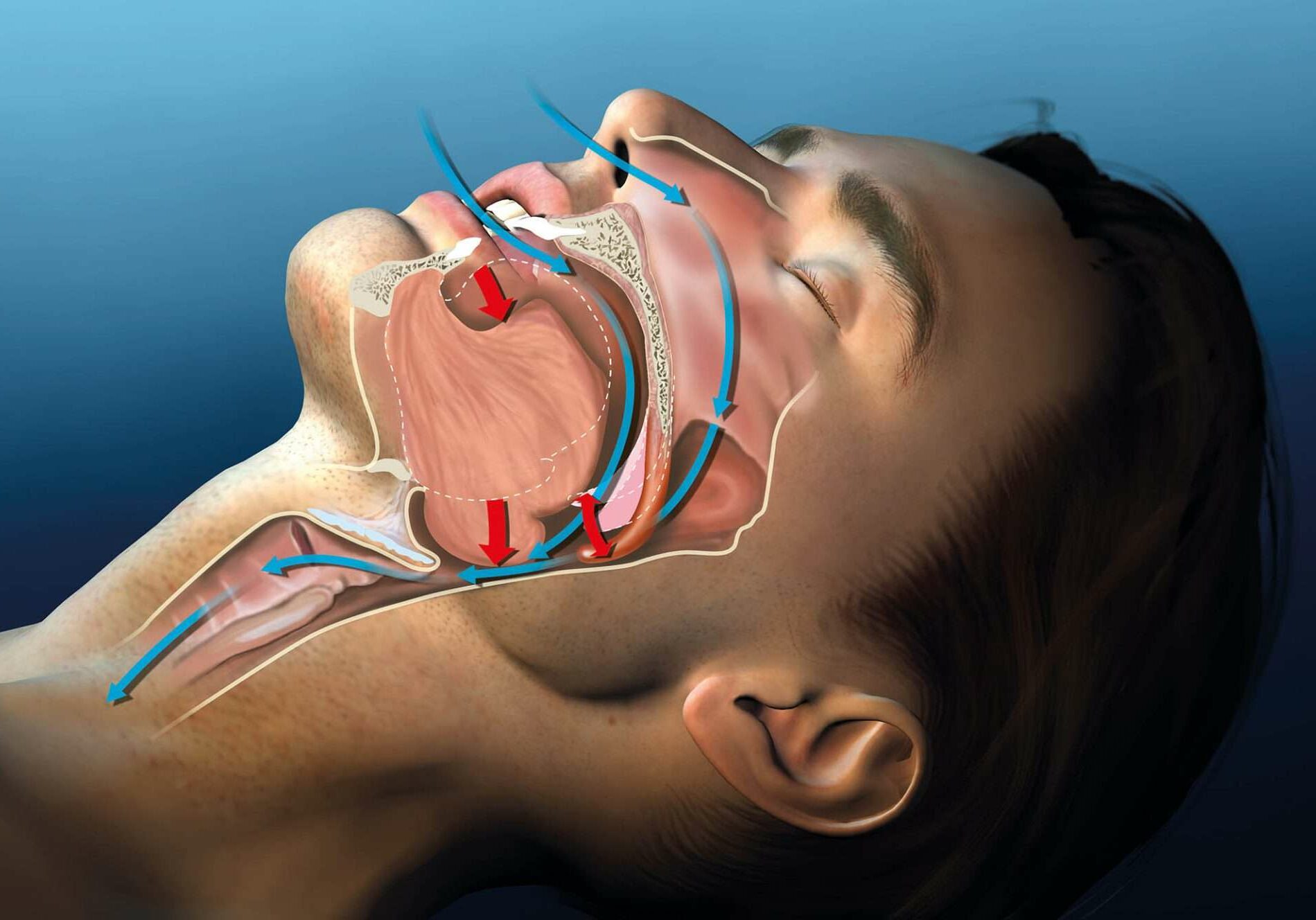 Snoring, medical illustration